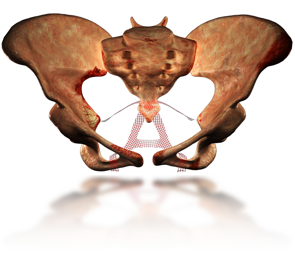 Prolapsul uterin vaginal tratament